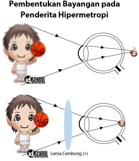 Proses Pembentukan Bayangan pada Penderita Rabun Dekat (Hipermetropi)