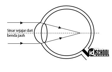 Soal Pembentukan Bayangan pada Penderita Miopi